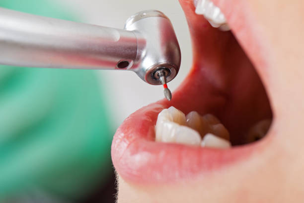 Best Urgent Care for Lost Fillings or Crowns in Muleshoe, TX